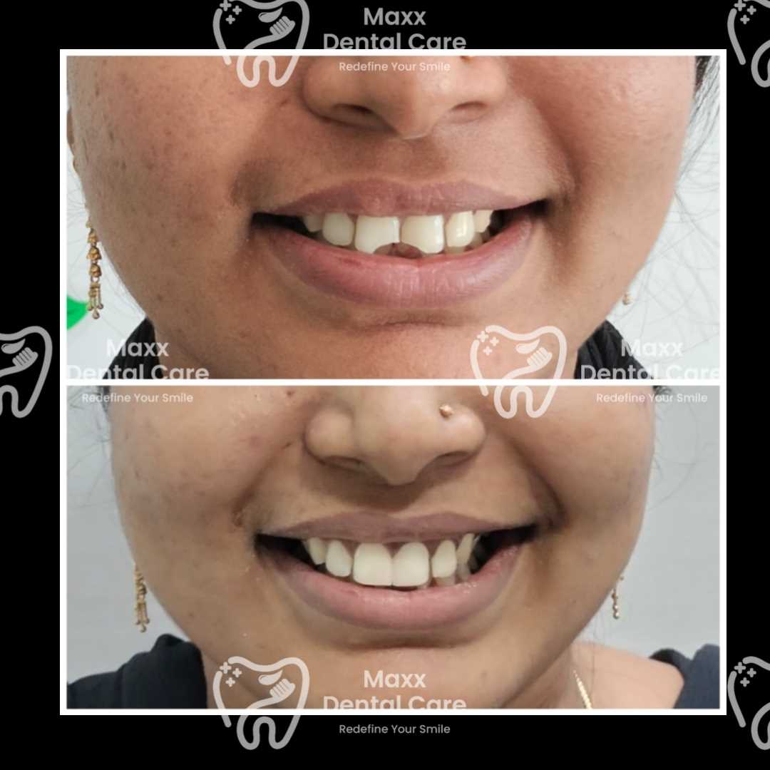 MAXX DENTAL CARE in 100 Feet Taramani Link Road, Velachery