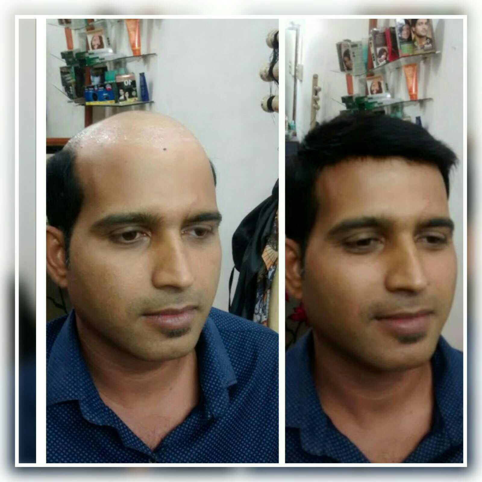 Hair Fixing Services in Mangalore, Bald Treatment | Sulekha Mangalore