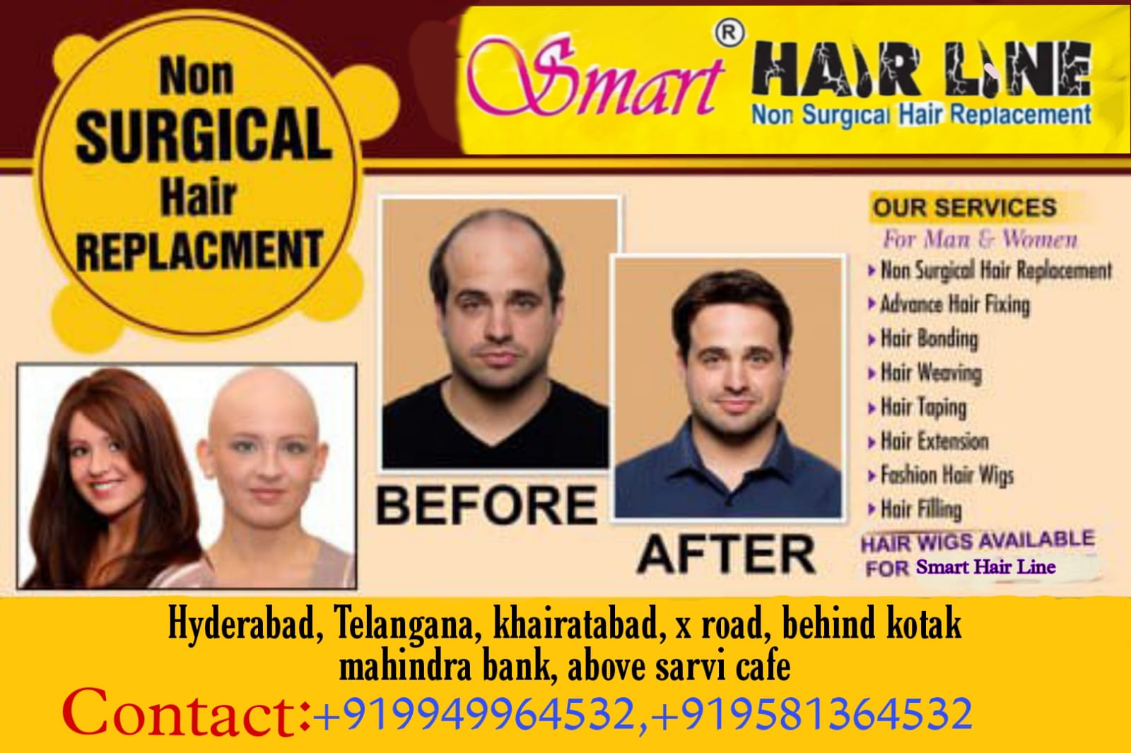 Hair Fixing Services in Hyderabad, Bald Treatment | Sulekha Hyderabad